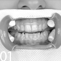 Лазерное отбеливание зубов Томск Профсоюзная стоматология на иркутском томск денталия