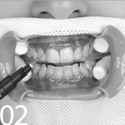 Фотоотбеливание зубов Томск Сосновый областная стоматология томска