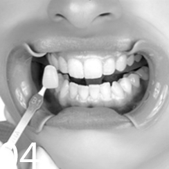 Лазерное отбеливание зубов Томск Рабочая 1-я Иссечение капюшона зуба мудрости Томск Королева