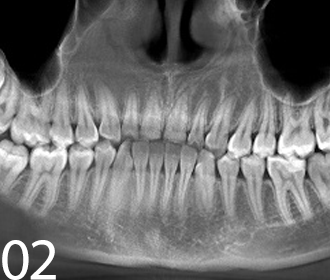 Снимок зуба Томск Инженерный стоматология в томске брекеты