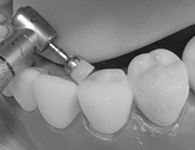 Фторирование зубов Томск Краснознаменная стоматология панацея в томске