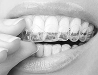 Покрытие зуба защитным лаком Томск Тимофеева томск сколько стоит вставить зуб