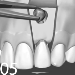 Удаление кисты зуба Томск Лесная 1-я элан стоматология томск