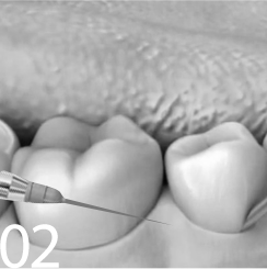 Удаление зуба Томск Невская Имплантация зубов «под ключ» Томск Румынский