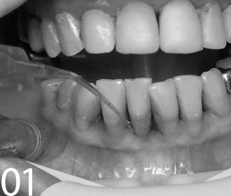 Снятие зубных отложений Томск Белая стоматология удаление зуба томск