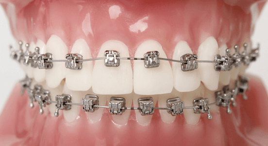 Самолигирующие брекеты Томск Рельефная детская стоматология в томске адреса