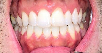 Капы для выравнивания зубов Томск Мира детская стоматология на почте томск