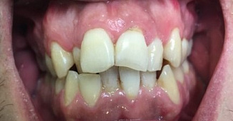 Капы для выравнивания зубов Томск Фрунзе имплантация зубов томск отзывы